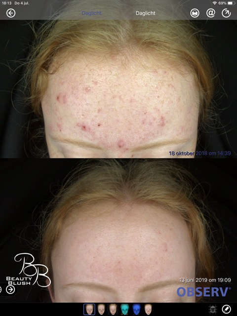 Blog acne